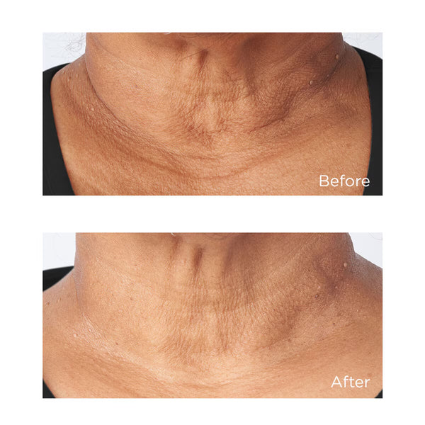 Perricone MD, Cold Plasma Plus+ Sub-D/Neck Treatment, 59ML