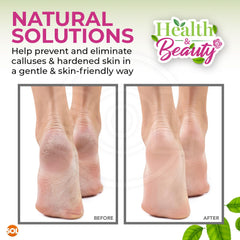 SOL 8pk Natural Pumice Stone for Feet | Callus Remover & Foot Scrubber | Exfoliating Stone for Dead Skin, Hard Skin, and Cracked Heels | Gentle Foot Buffer for Smooth, Soft, Healthy Skin